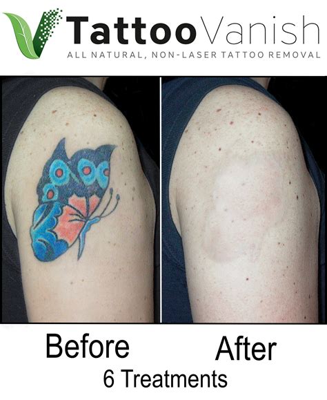 Pain After Laser Tattoo Removal / Non Laser Tattoo Removal