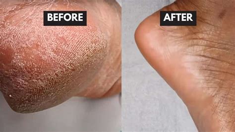 10 Best Ways To Clean Dead Skin Off Feet At Home