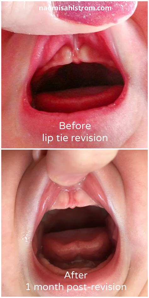 Unlocking Relief: Effective Ways to Fix a Lip Tie in Infants 
