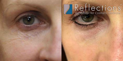 Revive and Rejuvenate: Mastering the Art of Fixing Crepey Skin Under Your Eyes