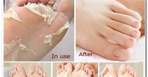Revive Your Feet with Ease: The Ultimate Guide to Banishing Dry Skin for Good