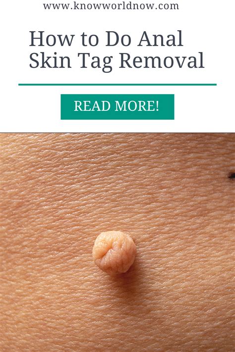 Banish the Embarrassment Forever: The Ultimate Guide to Eliminating Annoying Anal Skin Tags