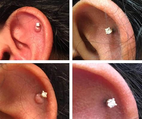 Pierce away the problem: 5 hassle-free tips to eliminate skin growing over your piercing!