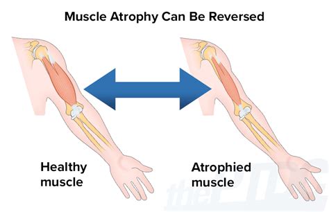 How To Prevent Muscle Atrophy In Older Adults