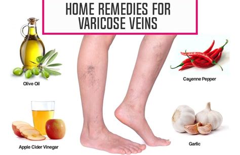 How To Prevent Varicose Veins Naturally