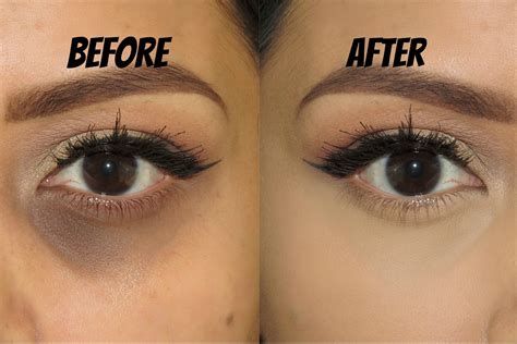 How To Reduce Dark Circles Under Eyes Naturally