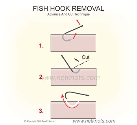 Mastering the Art of Hook Extraction: A Comprehensive Guide on How to Remove a Fish Hook from Skin