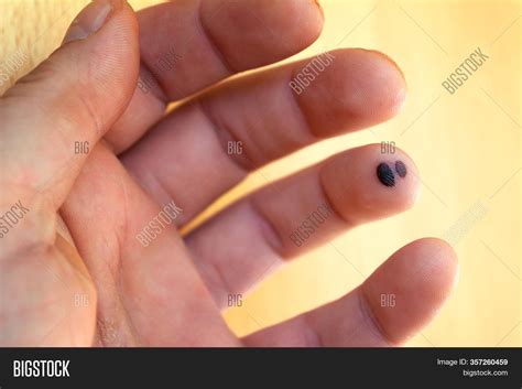 Say Goodbye to Stubborn Blood Stains! Learn How to Effortlessly Remove Dried Blood from Your Skin with These Quick and Easy Tips.