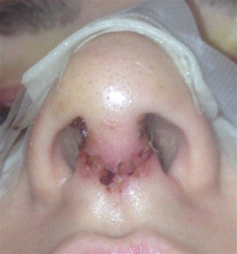 Slaying the Stains: A Comprehensive Guide on Banishing Dry Blood from Skin