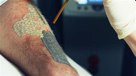 Fast Tattoo Removal How Can Remove Permanent Tattoo Does
