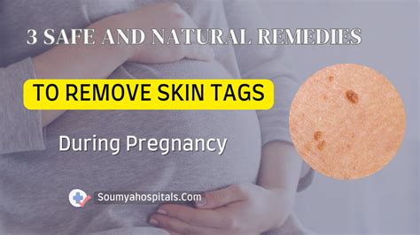 Pregnancy and Skin Tags: Be Gone in a Flash - Learn How to Remove Them with Our Simple Guide!