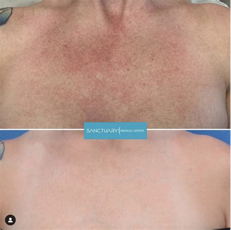 Reclaim Your Radiant Décolletage: The Ultimate Guide To Repairing Sun-Damaged Skin On Your Chest