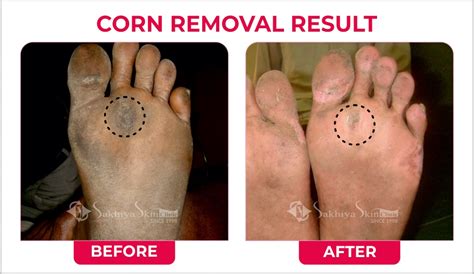 Unveiling the Ultimate Guide: Reclaiming Your Skin's True Hue After Corn Removal