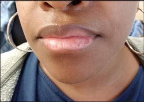 End the Pain: A Guide on How to Stop Biting the Skin off Your Lips