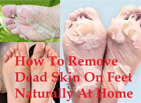 Get Summer-Ready Feet and Ditch Your Embarrassment with These Easy Tips to Remove Dead Skin
