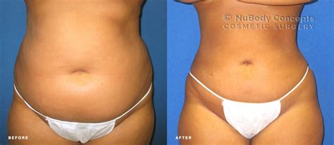 Revitalize Your Silhouette: Expert Tips on Tightening Loose Skin After Liposuction