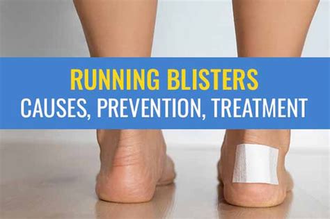 How To Treat Blisters From Running Naturally