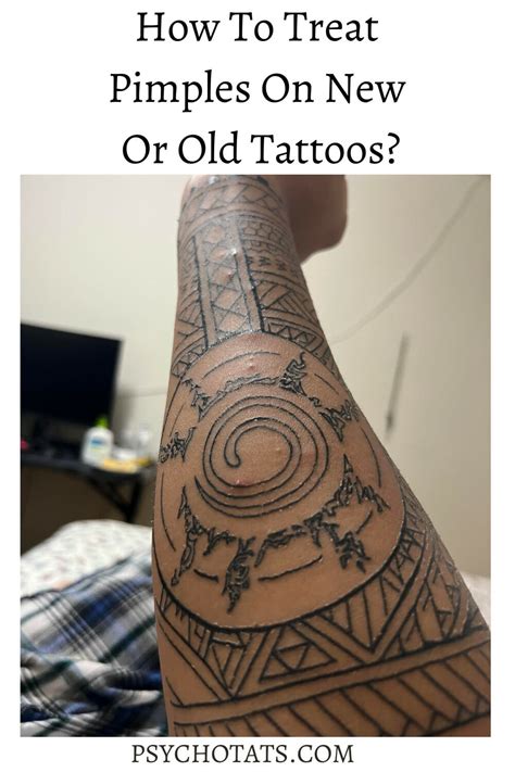 How To Treat Tattoo Pimples