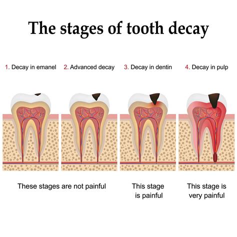 How Tooth Decay Leads to Head Pain