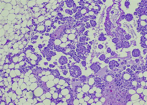 How Vt3989 Mesothelioma Develops