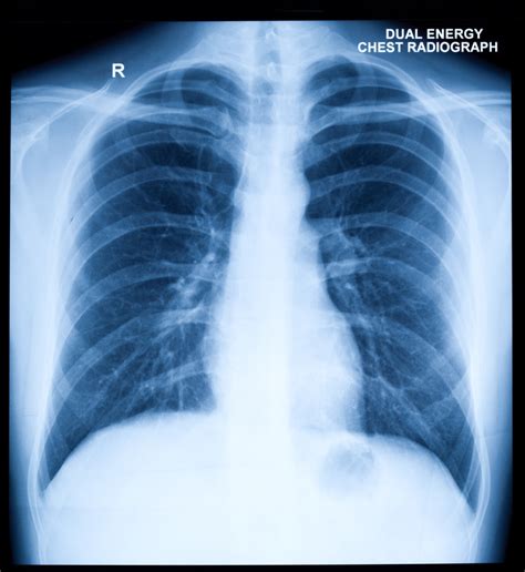 How a Chest X-Ray Can Spot Trouble