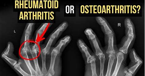 How is Rheumatoid Arthritis Distinguished from Osteoarthritis Quizlet?