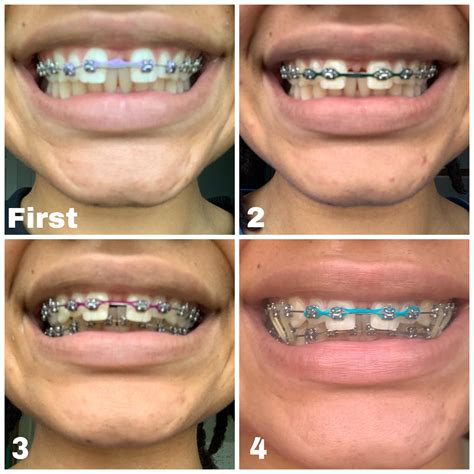 How long does it take to close gaps with braces?