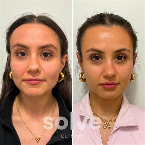 Masseter Botox Results Timeline