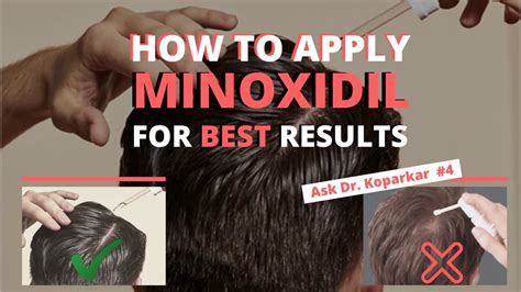 How to Apply Minoxidil