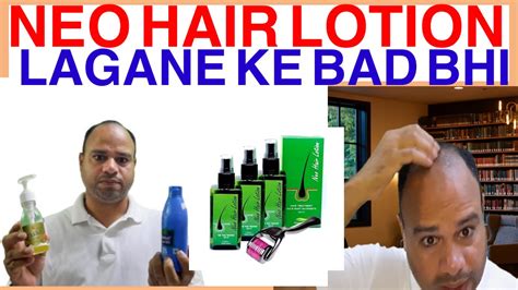 User Experience: How to Properly Apply Neo Hair Lotion for Max Results