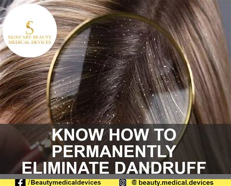 Ditch the Flakes: Discover the Ultimate Guide on Banishing Dandruff for Good