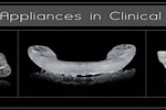 How to Fabricate Swallowing Occlusal Contact Intercept Appliance