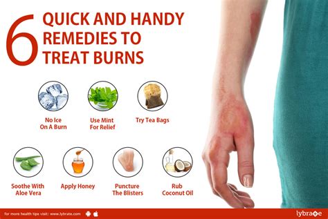 How to Heal a Burn