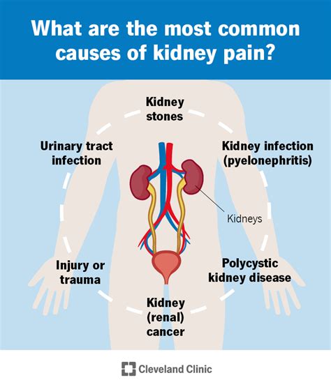 Kidney Pain Location, Pictures, Symptoms, Causes