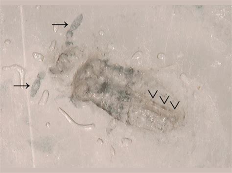 Protect Your Skin: How to Eliminate the Nightmare of Springtail Infestation in Humans