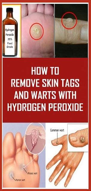 Amazing Benefits of Hydrogen Peroxide for Skin Tags Treatment: Say Goodbye To Unsightly Blemishes!