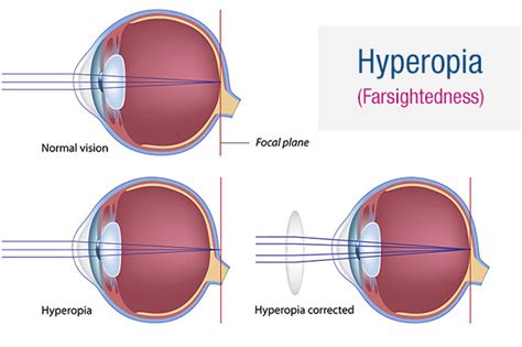 Hyperopia (Farsightedness)