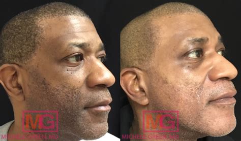 Unveiling the Secrets to Flawless, Radiant Skin: The Magic of Microneedling for Dark Skin Hyperpigmentation!