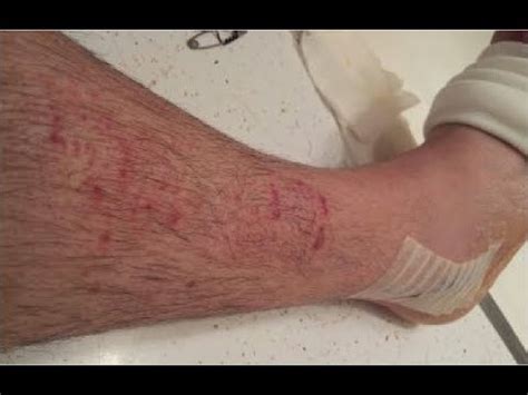 Unveiling the Delicate Dilemma: Navigating Hypersensitive Skin After Cast Removal