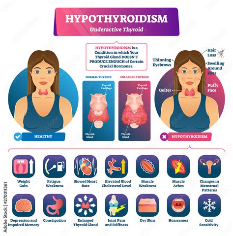 Hypothyroid