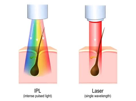 IPL vs. Diode Lasers