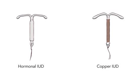 IUDs and Implants