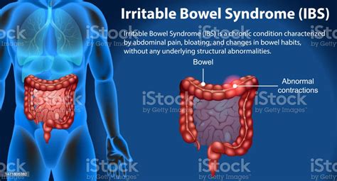Ibs
