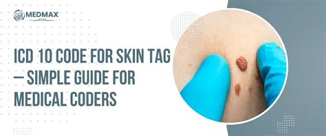 Say Goodbye to Shame & Discomfort: How to Easily Treat Skin Tags with the Ultimate Guide to ICD 10 Codes