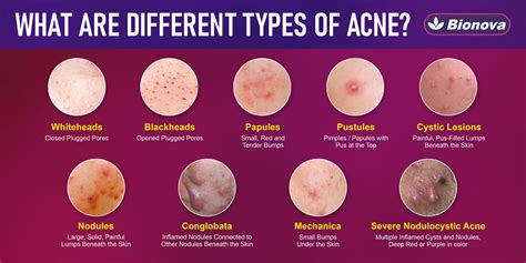 Identifying Types of Acne