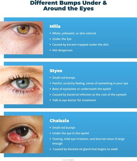 Identifying the Different Types of Eye Bumps