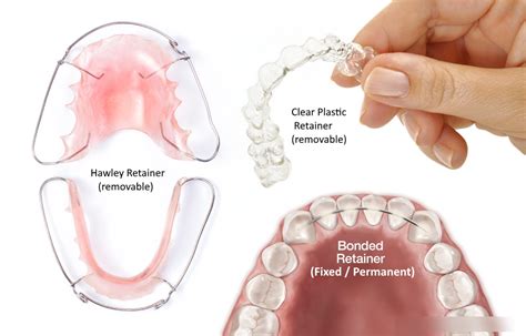 Identifying the Types of Retainers