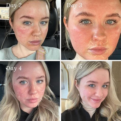 Image Chemical Peel