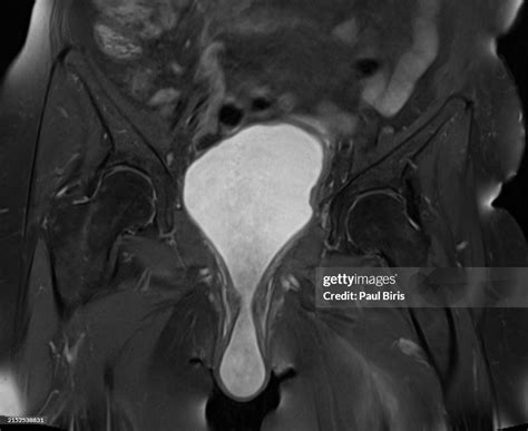 Image Of Prolapsed Bladder