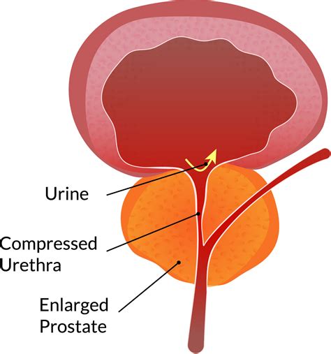 Image Of Prostate